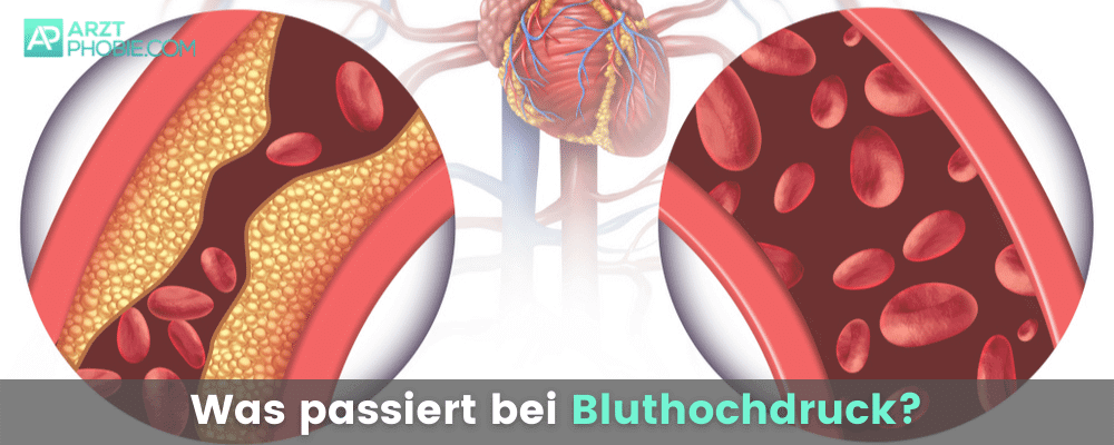 bluthochdruck-was-passiert