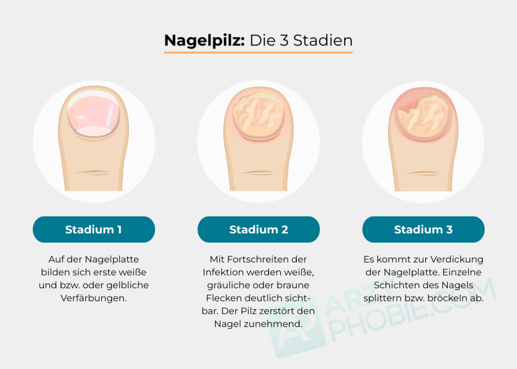 Nagelpilz-aussehen