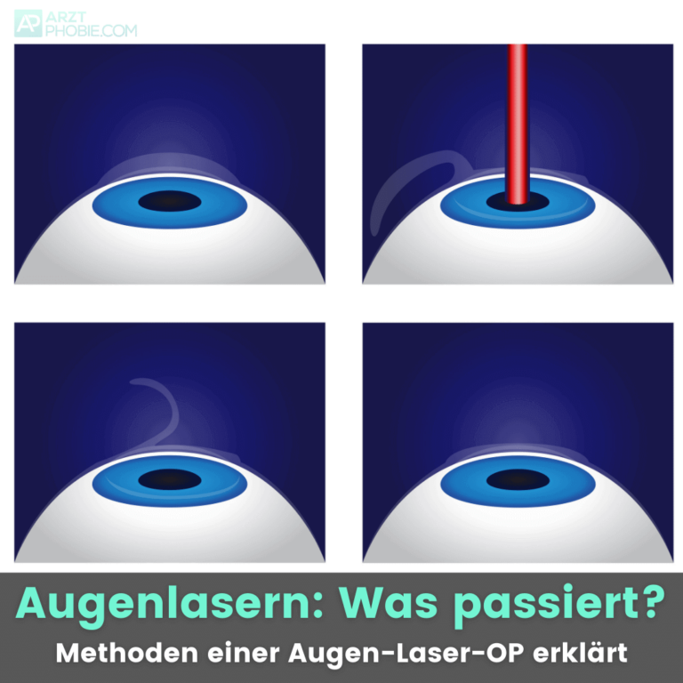 augenlasern-was-passiert