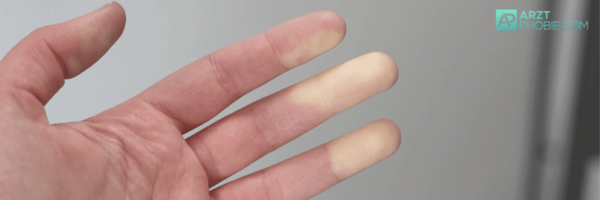 handschuhe-raynaud-syndrom-kalt-finger